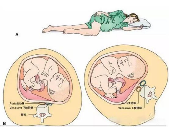 孕妇有静脉曲张要紧么？应该如何护理