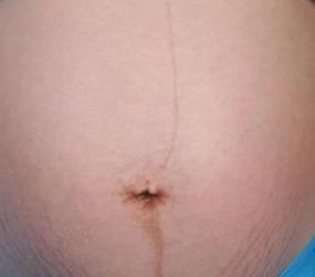 孕妇怎样才不长妊娠纹？如何防止妊娠纹增长