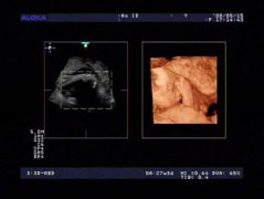 怀孕11周胎儿彩超图