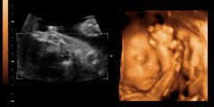 怀孕12周胎儿彩超图
