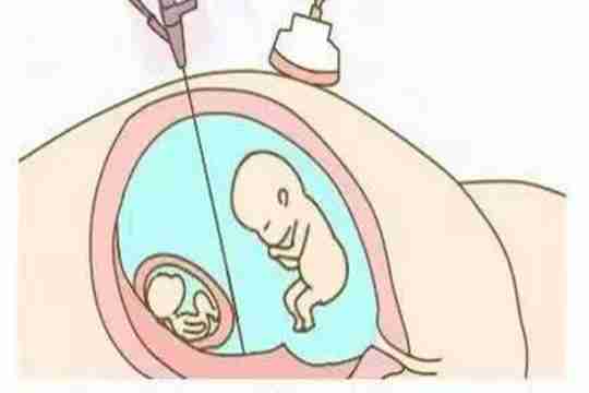 试管婴儿甚么时候减胎好?